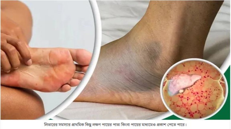 লিভারের সমস্যা আছে কিনা জানিয়ে দেবে পা, 